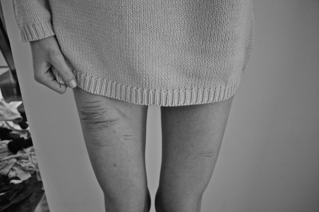 Why You Shouldn't Ask About People's Scars
