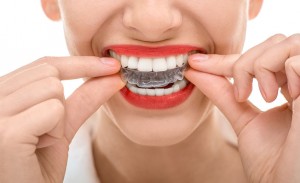 I Got Invisalign in College Because I Believed the Invisi-lies
