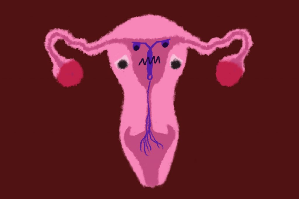 IUD