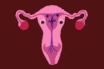IUD